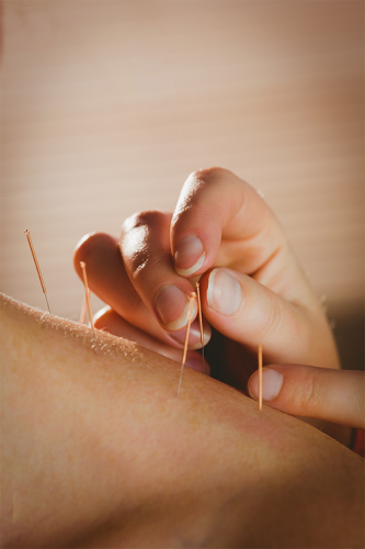young-woman-getting-acupuncture-treatment-in-thera-2023-11-27-05-00-07-utc